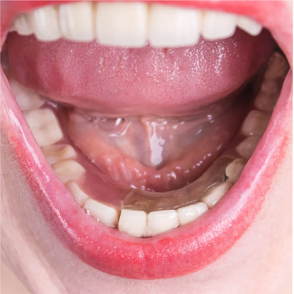 Before and after images of ruined teeth. These images show a result of the work of the dentist.