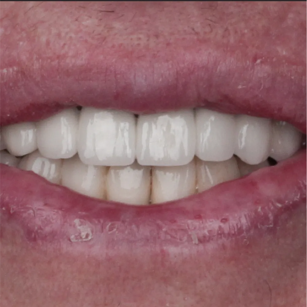 Before and after images of ruined teeth. These images show a result of the work of the dentist.