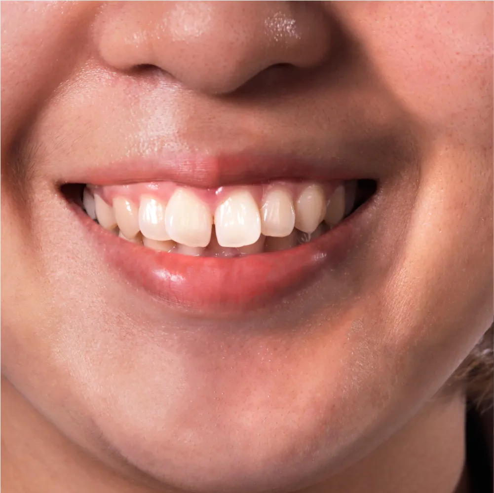 Before and after images of ruined teeth. These images show a result of the work of the dentist.