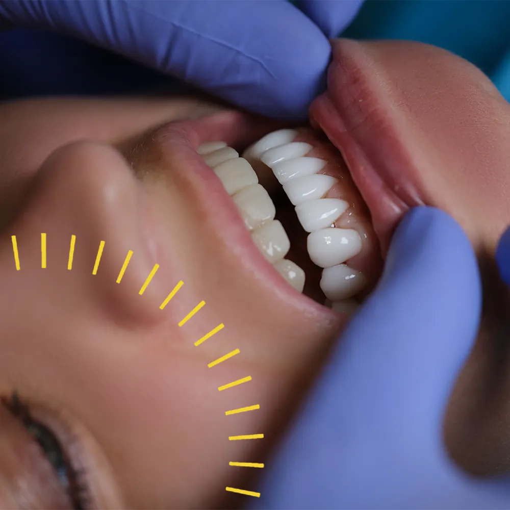 Porcelain Veneers
