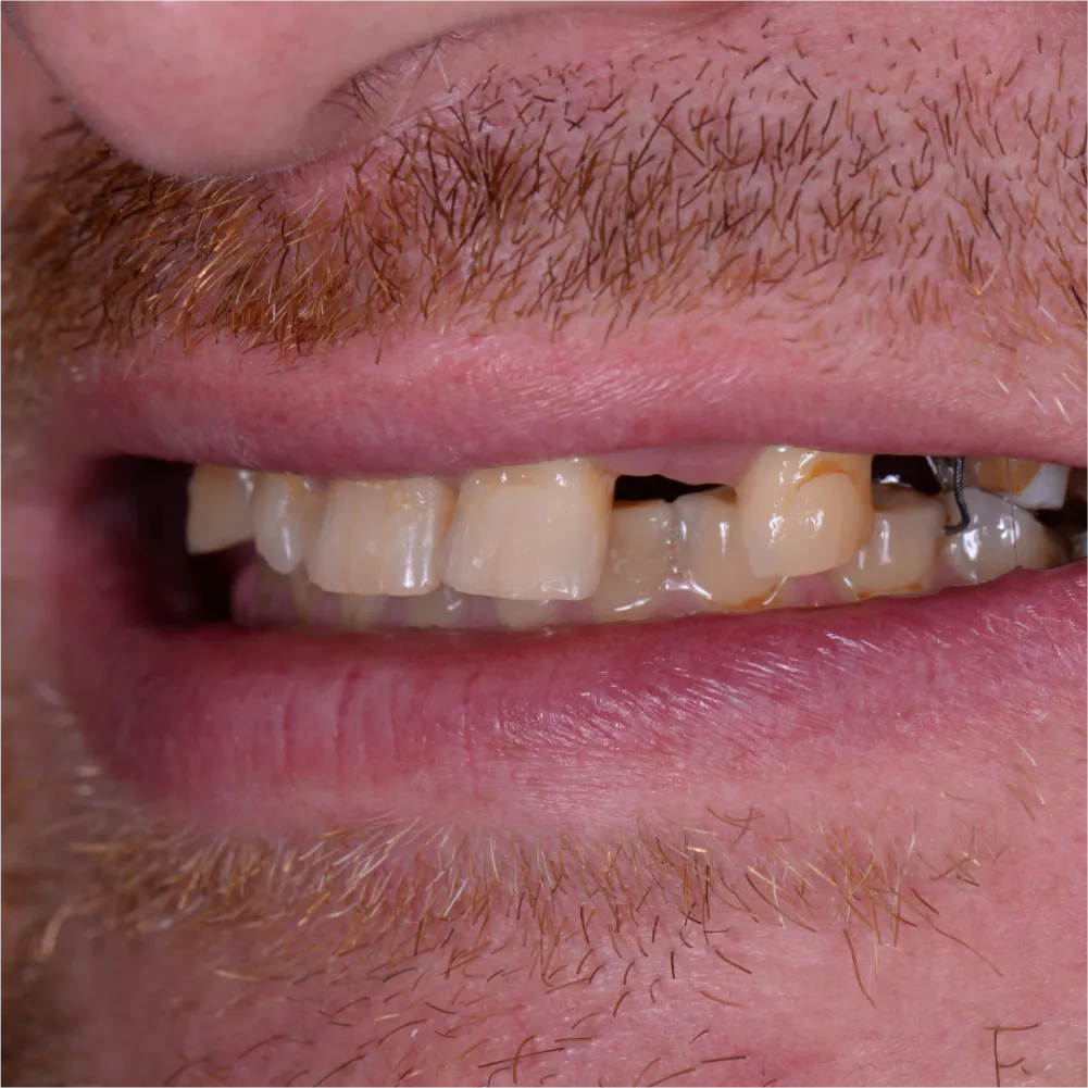 Before and after images of ruined teeth. These images show a result of the work of the dentist.