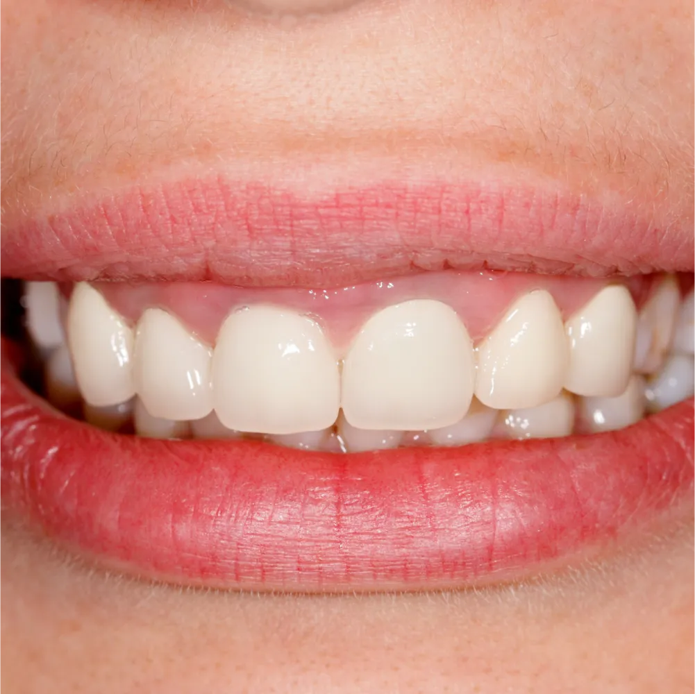 Before and after images of ruined teeth. These images show a result of the work of the dentist.