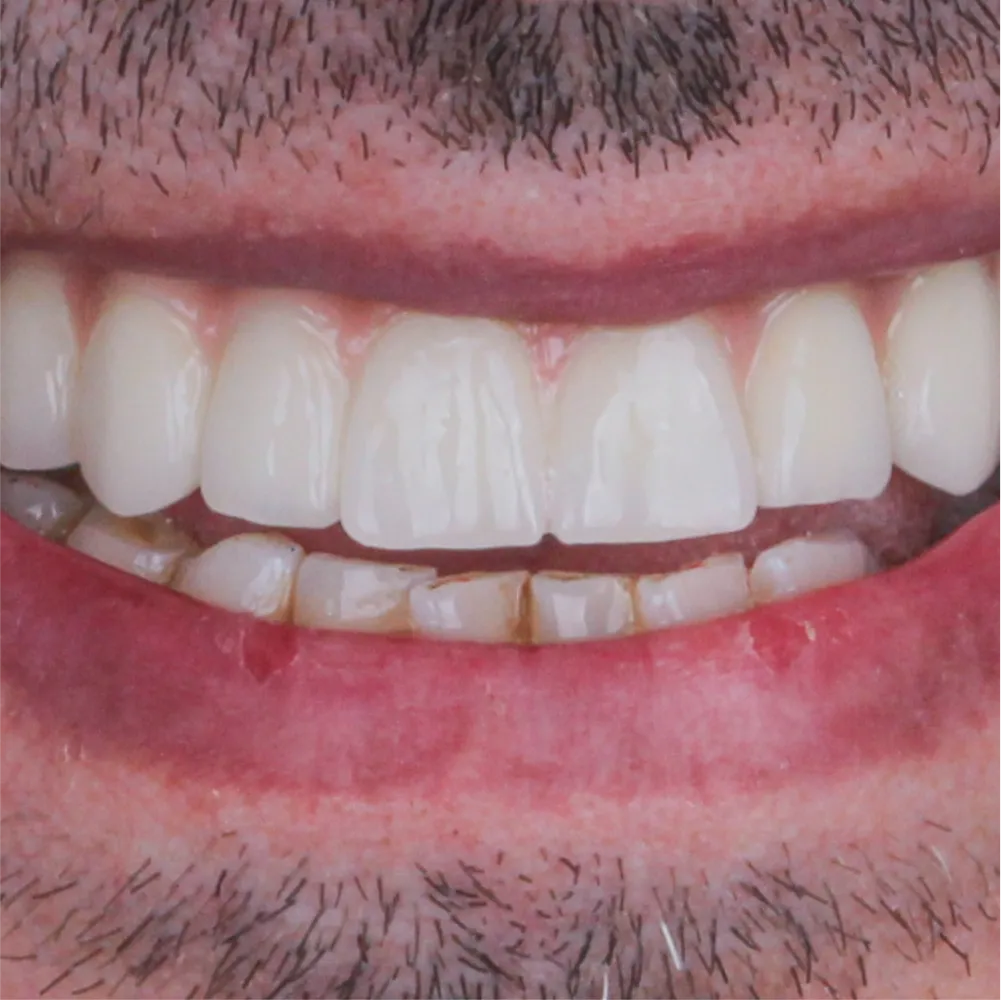 Before and after images of ruined teeth. These images show a result of the work of the dentist.