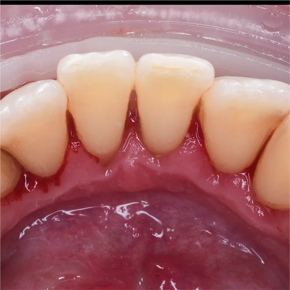 Before and after images of ruined teeth. These images show a result of the work of the dentist.