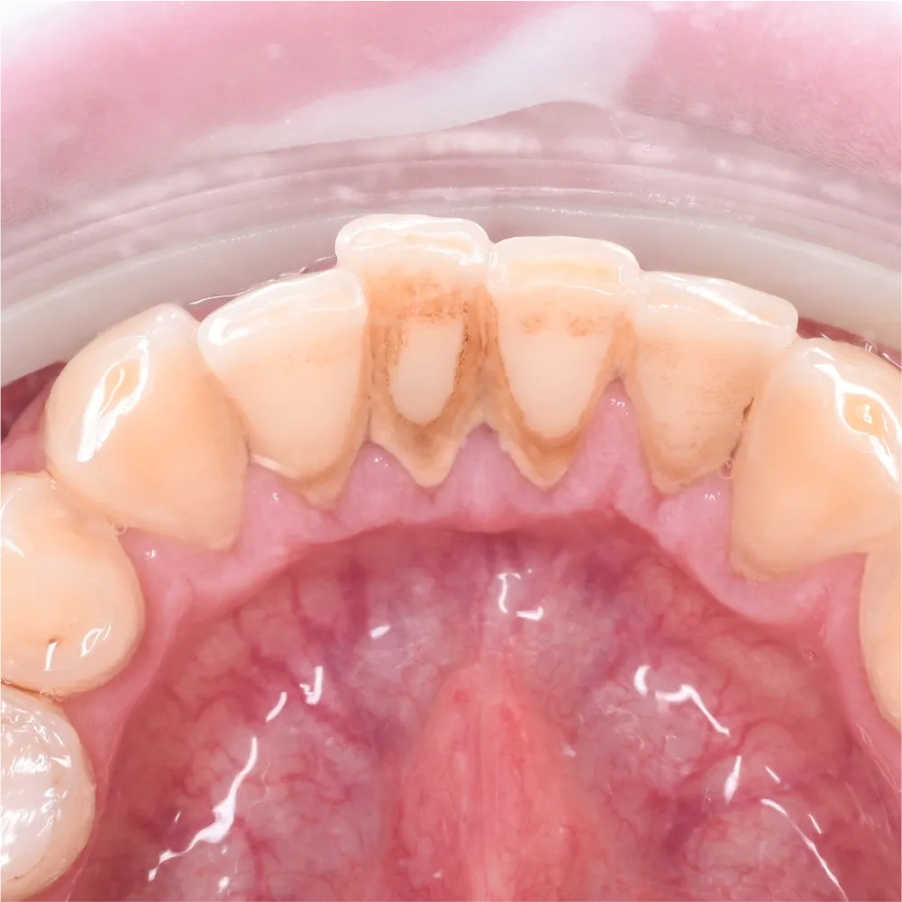 Before and after images of ruined teeth. These images show a result of the work of the dentist.