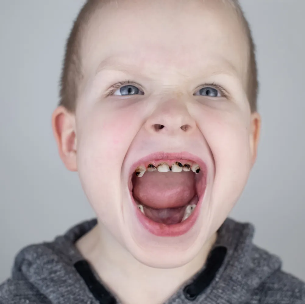 Before and after images of ruined teeth. These images show a result of the work of the dentist.